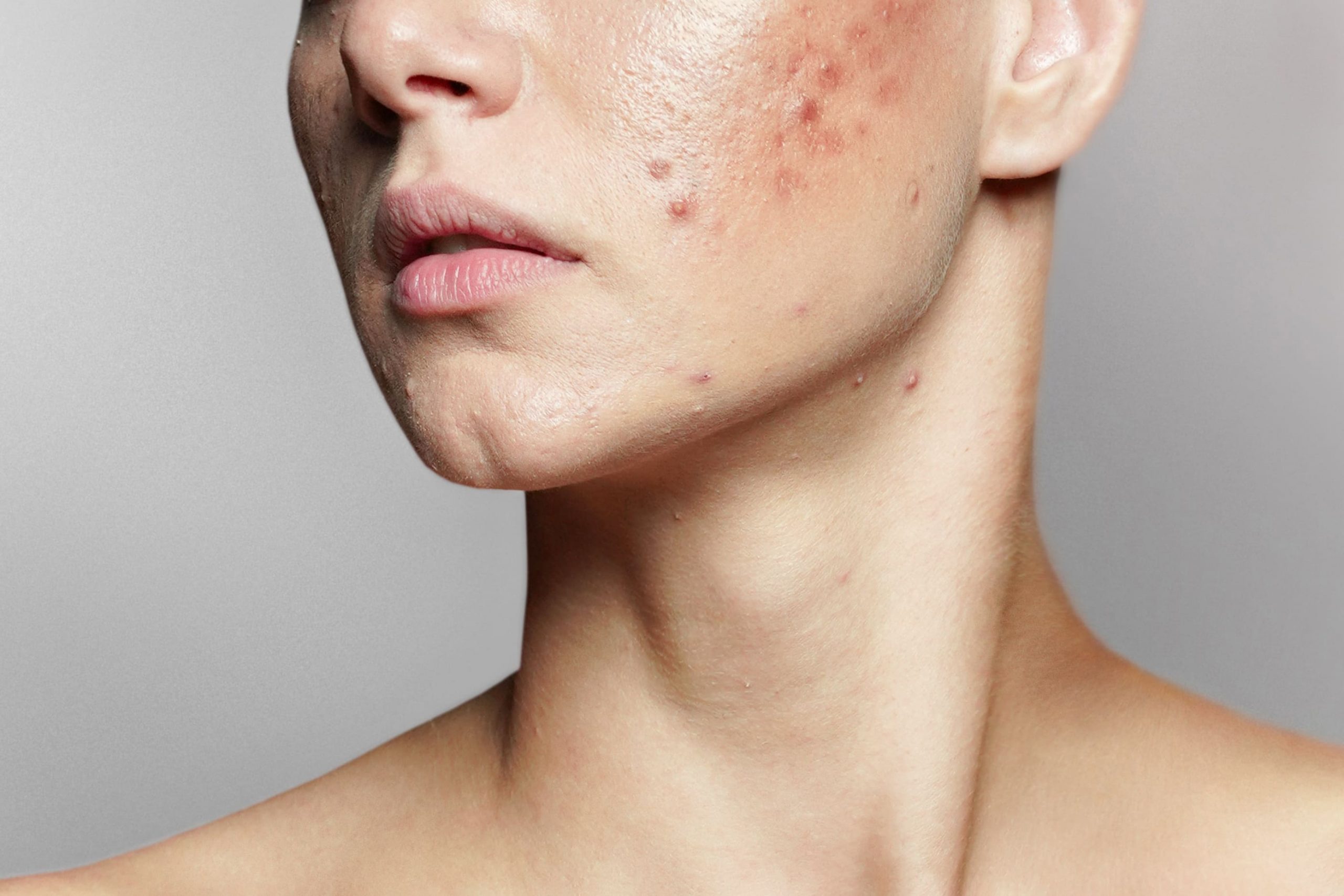 acne-hero-scaled